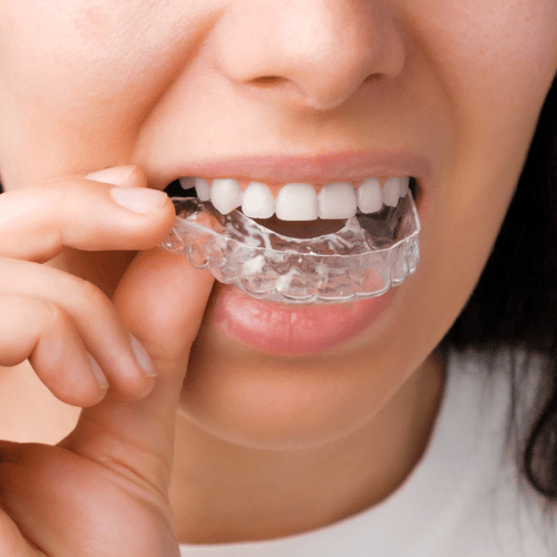 Woman putting Invisalign clear aligners on her teeth.