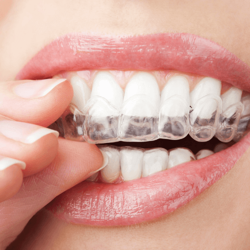 Woman putting in Invisalign aligners.