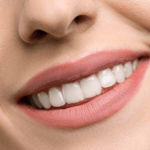 Woman smiling with clear braces and white teeth